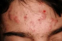 fig.1. clinical signs of acute inflammation present with acne