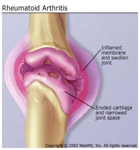 fig 4 rheumatoid_arthritis